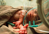 View of a premature baby in an incubator