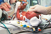 Premature baby in respiratory distress