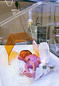 Neonatal jaundice treatment