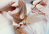 Umbilical venous catheter