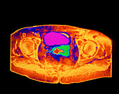 Coloured MRI of female pelvis in cervical cancer