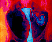 Infertility: f/col X-ray showing blocked tubes