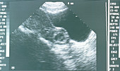 Ultrasound image of an ectopic pregnancy