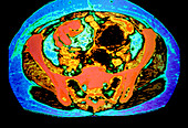 Coloured CT scan showing cancer of uterus & ovary