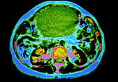 Coloured CT scan showing a large ovarian cancer