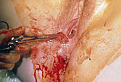 Close up of episiotomy wound exploration