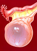 Illustration of an ovarian (follicular) cyst