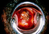View of a cervix stained with iodine (coloscopy)