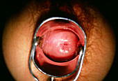 View of healthy,normal cervix