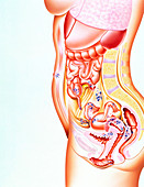 Artwork showing sites of endometriosis in body