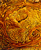 Coloured SEM of adenocarcinoma of the human uterus
