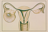 Artwork showing large ovarian cyst