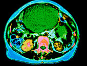 Coloured CT scan of ovarian cancer