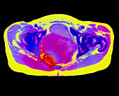 Colour CT scan of uterine cancer (leiomyosarcoma)
