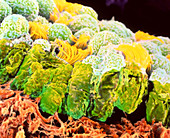 Coloured SEM of a Granulosa tumour cells in ovary