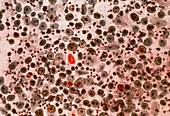 LM of atrophic vaginal cells from an elderly woman
