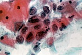 LM of cervical smear showing severe dysplasia