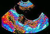 Coloured ultrasound scan of uterus with fibroma