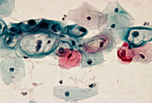 LM of cervical smear revealing HPV infection