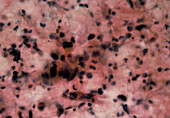 LM of cervical smear showing squamous carcinoma