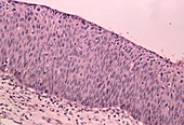 LM of cervix showing severe dysplasia (CIN 3)