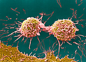 Coloured SEM of cervical cancer cells dividing