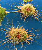 Coloured SEM of cervical cancer cells