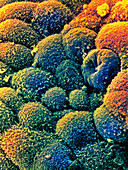 Coloured SEM of cancer cells of the ovary