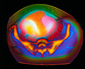 Coloured MRI scan of ovarian cancer