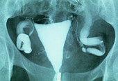 Swollen Fallopian tubes,X-ray