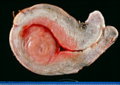 Uterine tumour