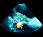 Ectopic pregnancy,ultrasound scan