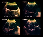 Uterine growth,ultrasound scans
