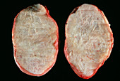 Benign ovary tumour