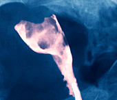 Uterine cancer,X-ray