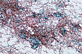 Cervical smear containing blood