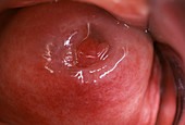 Cervical polyp