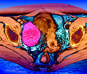Ovarian cyst,MRI