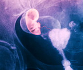Ectopic pregnancy,X-ray