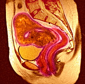 Uterine fibroid,MRI scan