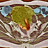 Uterine fibroid,MRI scan