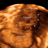 Uterine fibroid in pregnanacy,ultrasound