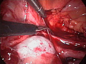Ovarian adhesion surgery