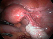 Ovarian biopsy