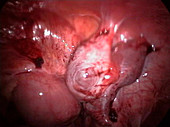 Ovarian adhesion