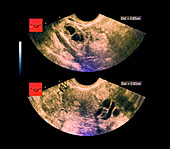 Ovarian cysts,ultrasound scan