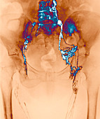 Secondary lymph gland cancer,X-ray
