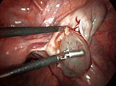Removal of an ovarian cyst (4 of 4)