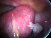 Ovarian adhesions to the uterus