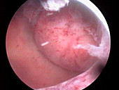 Uterine fibroid